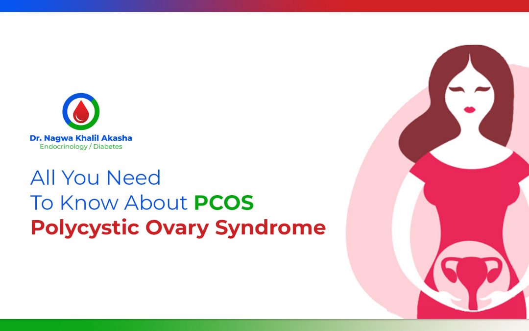 What is PCOS – Polycystic Ovary Syndrome?